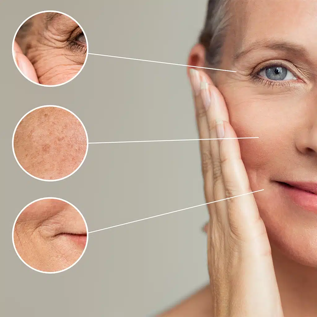 Woman with visible skin aging, illustrating AGE Scanner insights on Advanced Glycation End-products
